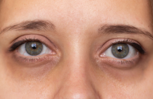 Ljekar otkrio šta podočnjaci govore o vašem zdravlju: Ako vam se dogodi jedno, hitno idite doktoru