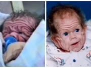 Zbog rijetkog poremećaja izgledao je kao stogodišnja beba, a pogledajte ga danas