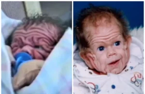 Zbog rijetkog poremećaja izgledao je kao stogodišnja beba, a pogledajte ga danas