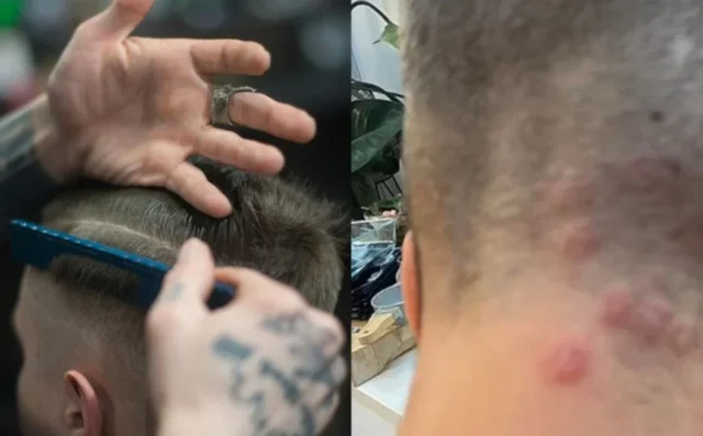 frizer-gljivicna-infekcija