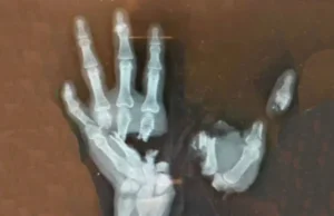 Ovako izgleda šaka dječaka koju je uništila eksplozija petarde