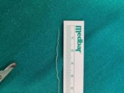 Banjalučki doktor objavio fotografiju: Iz kapka odstranjen crv od 6 cm